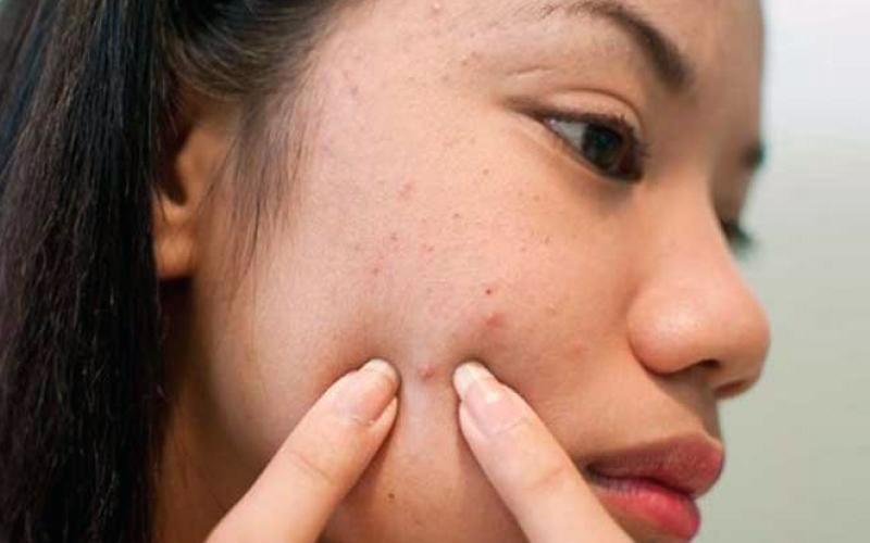 Maganda Ako! ᐅ Gamot Sa Pimples: Ano Ba Ang Mabisang Gamot Sa Tigyawat